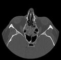 Acute sinusitis (Radiopaedia 23161-23215 Axial bone window 40).jpg
