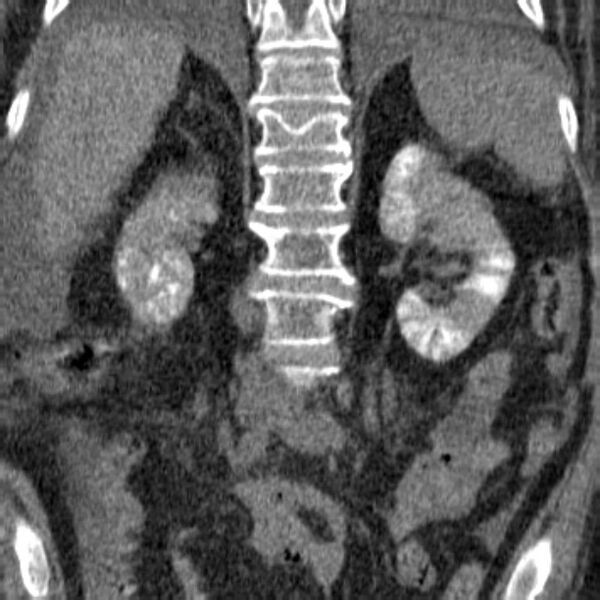 File:Acute tubular necrosis (Radiopaedia 28077-28334 Coronal non-contrast 12).jpg