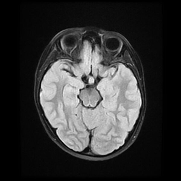 File:Adamantinomatous craniopharyngioma (Radiopaedia 77407-89529 Axial FLAIR 10).jpg