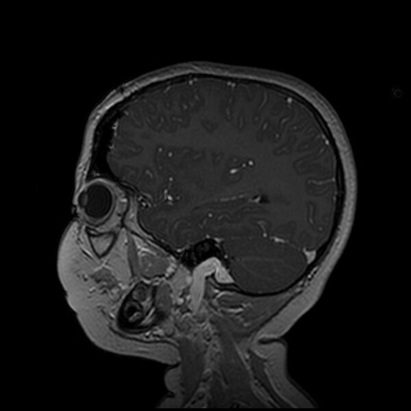 File:Adamantinomatous craniopharyngioma (Radiopaedia 77407-89529 H 35).jpg