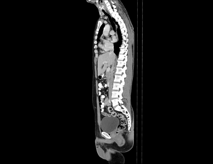 Addison disease (Radiopaedia 49318-54412 Sagittal C+ portal venous phase 38).jpg