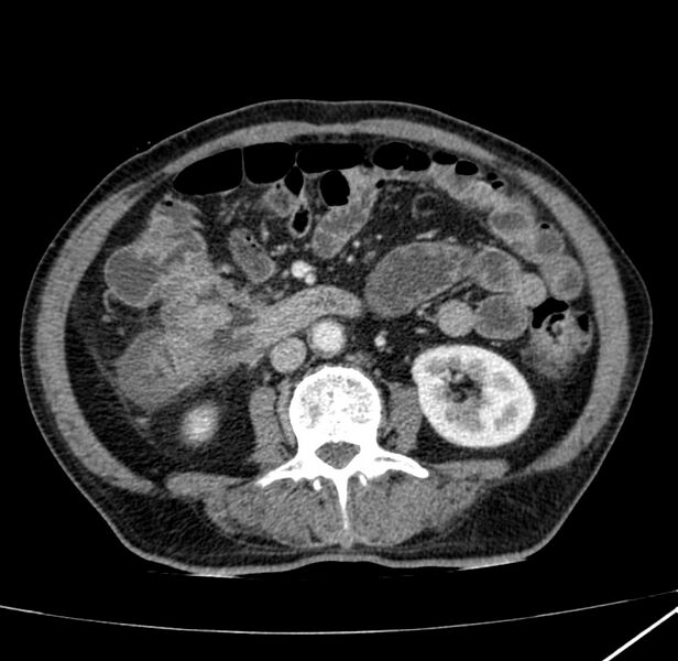 File:Adenocarcinoma of colon with entero-colic fistula (Radiopaedia 22832-22852 Axial C+ portal venous phase 39).jpg