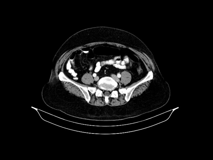 Adenocarcinoma of pancreas with hepatic metastasis (Radiopaedia 64332-73122 Axial C+ portal venous phase 73).jpg