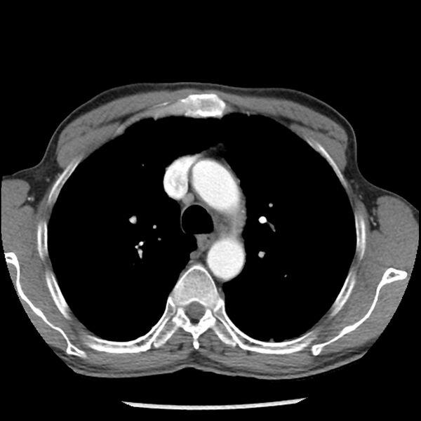 File:Adenocarcinoma of the lung - micropapillary predominant (Radiopaedia 42446-45563 Axial C+ portal venous phase 22).jpg