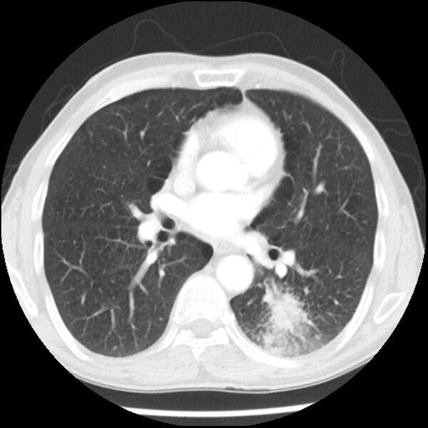 File:Adenocarcinoma of the lung - micropapillary predominant (Radiopaedia 42446-45563 Axial lung window 39).jpg