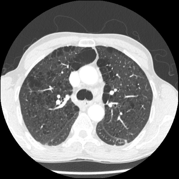 File:Adenocarcinoma of the lung - micropapillary predominant (Radiopaedia 42446-45563 C 7).jpg