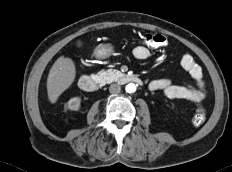 File:Adenomyomatosis of the gallbladder (Radiopaedia 12142-12483 Axial C+ arterial phase 22).jpg