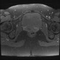 Adenomyosis and endometriotic cysts (Radiopaedia 82300-96367 Axial T1 fat sat 1).jpg