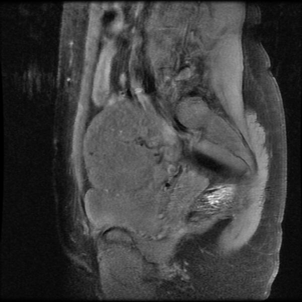 File:Adenomyosis on MRI (Radiopaedia 29328-29780 Sagittal T1 fat sat 4).jpg