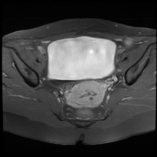 File:Adenomyosis within a septate uterus (Radiopaedia 69963-79981 Axial T1 C+ fat sat 15).jpg