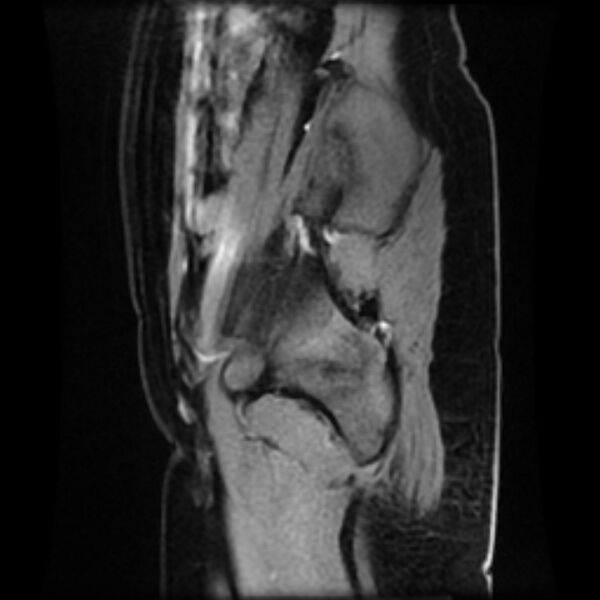 File:Adenomyosis within a septate uterus (Radiopaedia 69963-79981 Sagittal LAVA-Dyn 2).jpg
