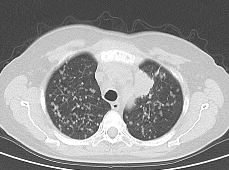 File:Adenosquamous lung carcinoma (Radiopaedia 22035-22030 lung window 21).jpg