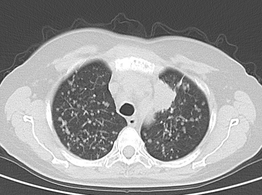 Adenosquamous lung carcinoma (Radiopaedia 22035-22030 lung window 21).jpg