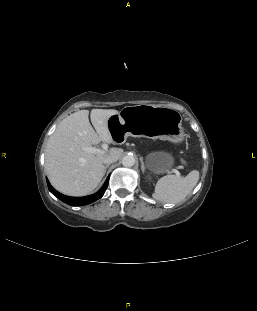 Adhesional small bowel obstruction (Radiopaedia 85402-101024 Axial C+ portal venous phase 70).jpg