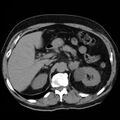 Adrenal hemangioma (Radiopaedia 11039-11445 Axial non-contrast 7).jpg