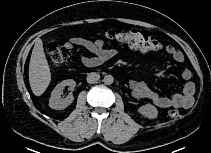 File:Adrenal metastases (Radiopaedia 73082-83791 Axial non-contrast 88).jpg