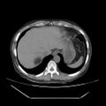 Adrenal myelolipoma (Radiopaedia 41843-44834 Axial non-contrast 3).jpg