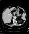 Adrenal myelolipoma (Radiopaedia 6765-7960 Axial C+ arterial phase 7).jpg