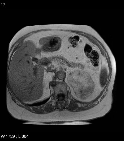 File:Adrenal myelolipoma (Radiopaedia 6765-7961 Axial T1 in-phase 17).jpg