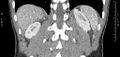 Adrenal pheochromocytoma (Radiopaedia 35133-36726 Coronal C+ portal venous phase 1).jpg