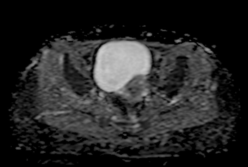 File:Adult granulosa cell tumor of the ovary (Radiopaedia 71581-81950 Axial ADC 15).jpg