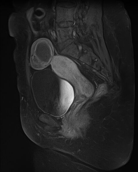 File:Adult granulosa cell tumor of the ovary (Radiopaedia 71581-81950 Sagittal T1 C+ fat sat 14).jpg