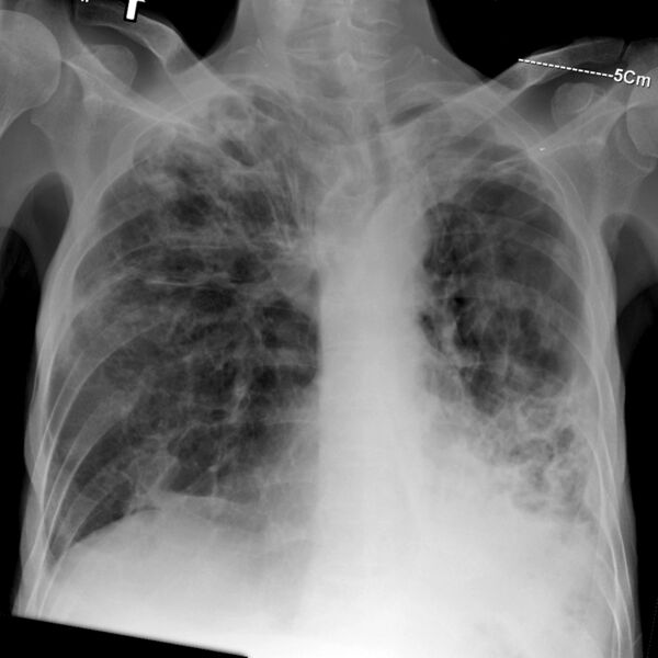 File:Advanced pulmonary tuberculosis (Radiopaedia 8599-9430 Frontal 1).jpg