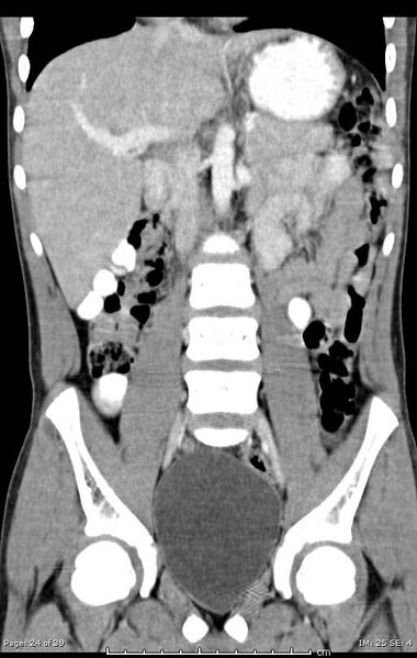 File:Agenesis of the gallbladder (Radiopaedia 55454-61905 A 24).jpg