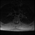 Aggressive vertebral hemangioma (Radiopaedia 39937-42404 Axial T1 C+ fat sat 28).png