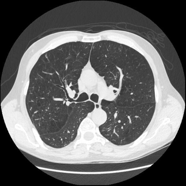 File:Alpha-1-antitrypsin deficiency (Radiopaedia 40993-43722 Axial lung window 93).jpg