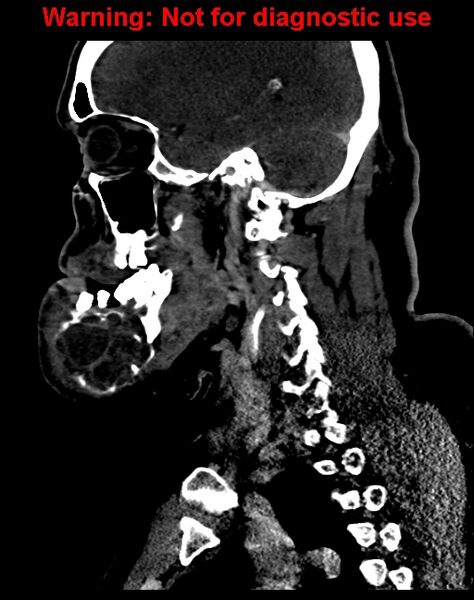 File:Ameloblastoma (Radiopaedia 33126-34164 F 46).jpg