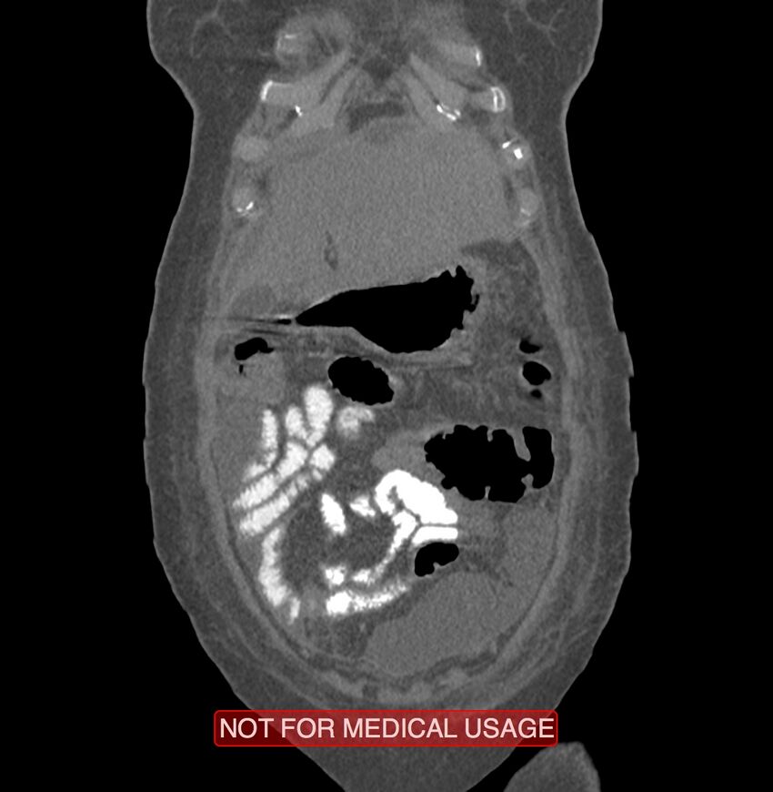Amoebic enterocolitis with liver abscess (Radiopaedia 35100-36609 B 16).jpg