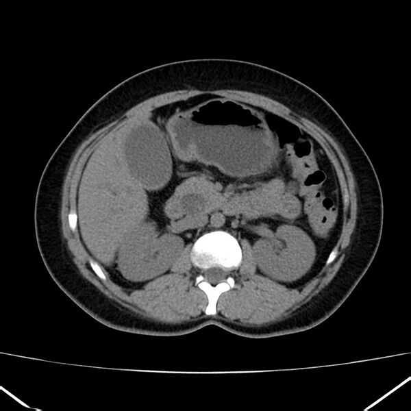 File:Ampullary tumor (Radiopaedia 22787-22816 Axial non-contrast 22).jpg
