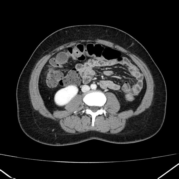 File:Ampullary tumor (Radiopaedia 22787-22816 C 36).jpg
