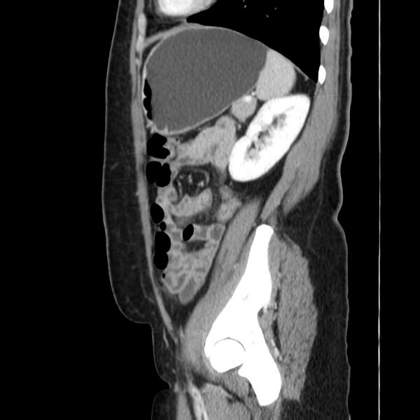 File:Ampullary tumor (Radiopaedia 22787-22816 D 41).jpg