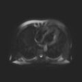 Ampullary tumor (Radiopaedia 27294-27479 T2 SPAIR 21).jpg