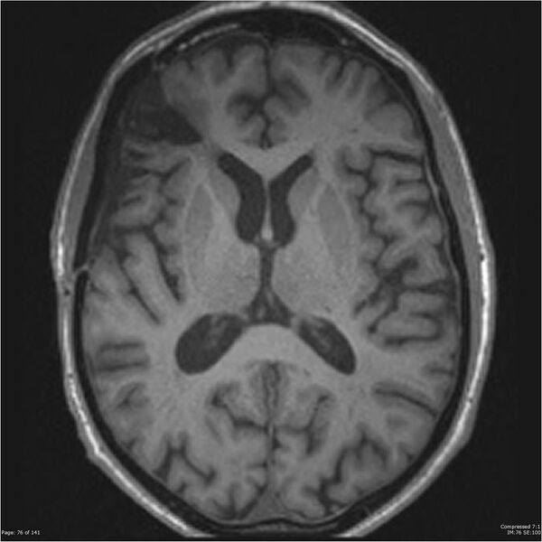 File:Anaplastic meningioma with recurrence (Radiopaedia 34452-35788 Axial T1 74).jpg
