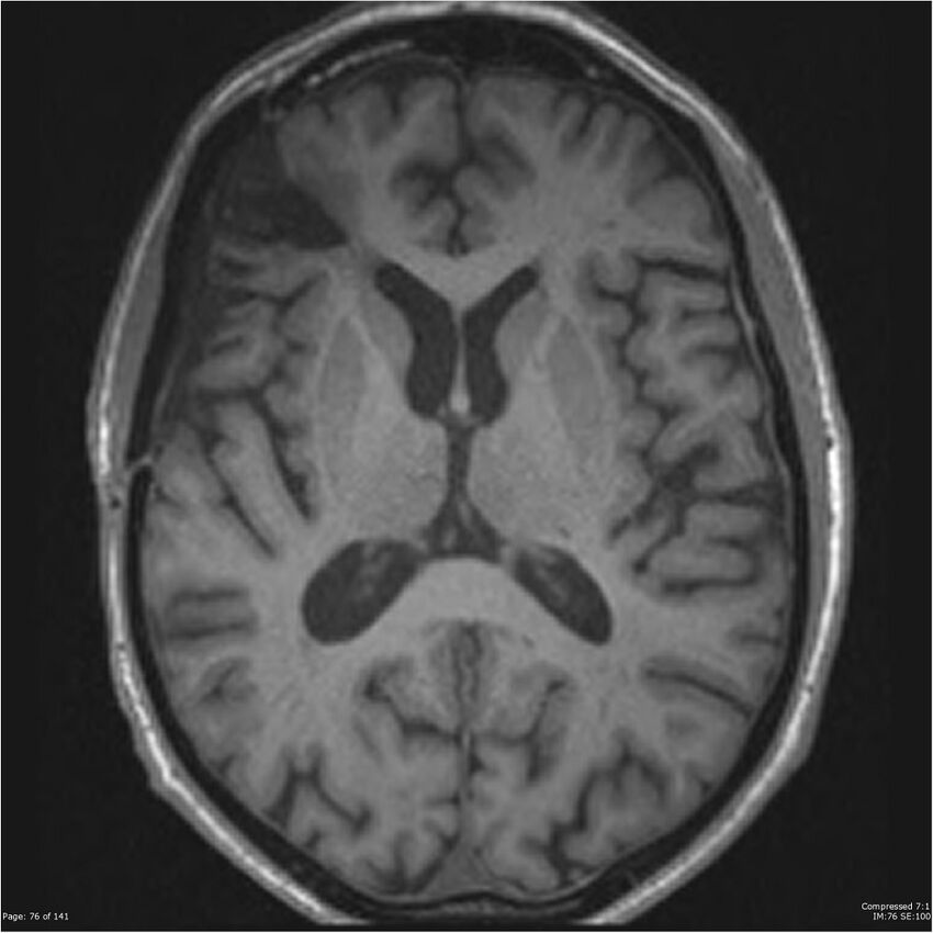 Anaplastic meningioma with recurrence (Radiopaedia 34452-35788 Axial T1 74).jpg