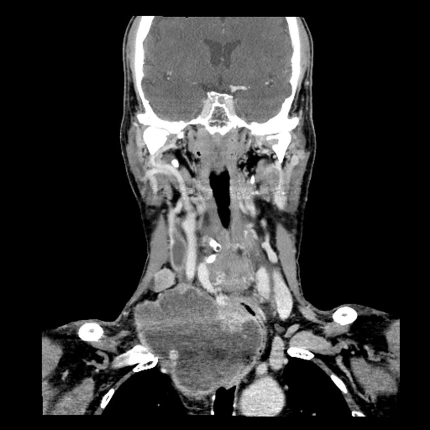 Anaplastic thyroid carcinoma (Radiopaedia 79087-92034 A 63).jpg