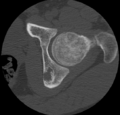 Aneurysmal bone cyst of ischium (Radiopaedia 25957-26094 B 15).png