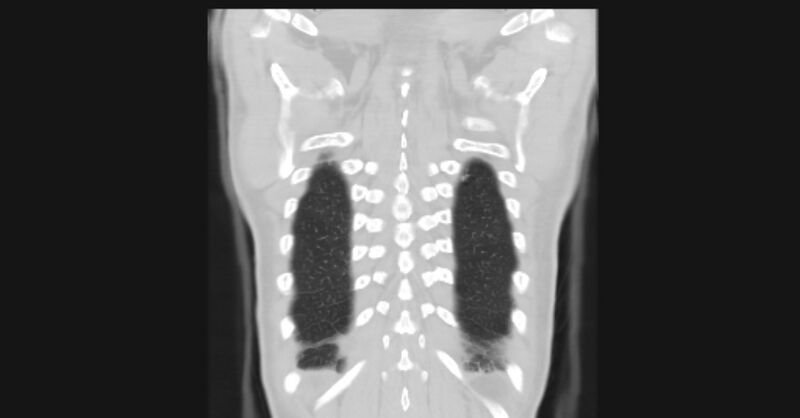 File:Angioinvasive aspergellosis (Radiopaedia 66995-76315 Coronal lung window 57).jpg