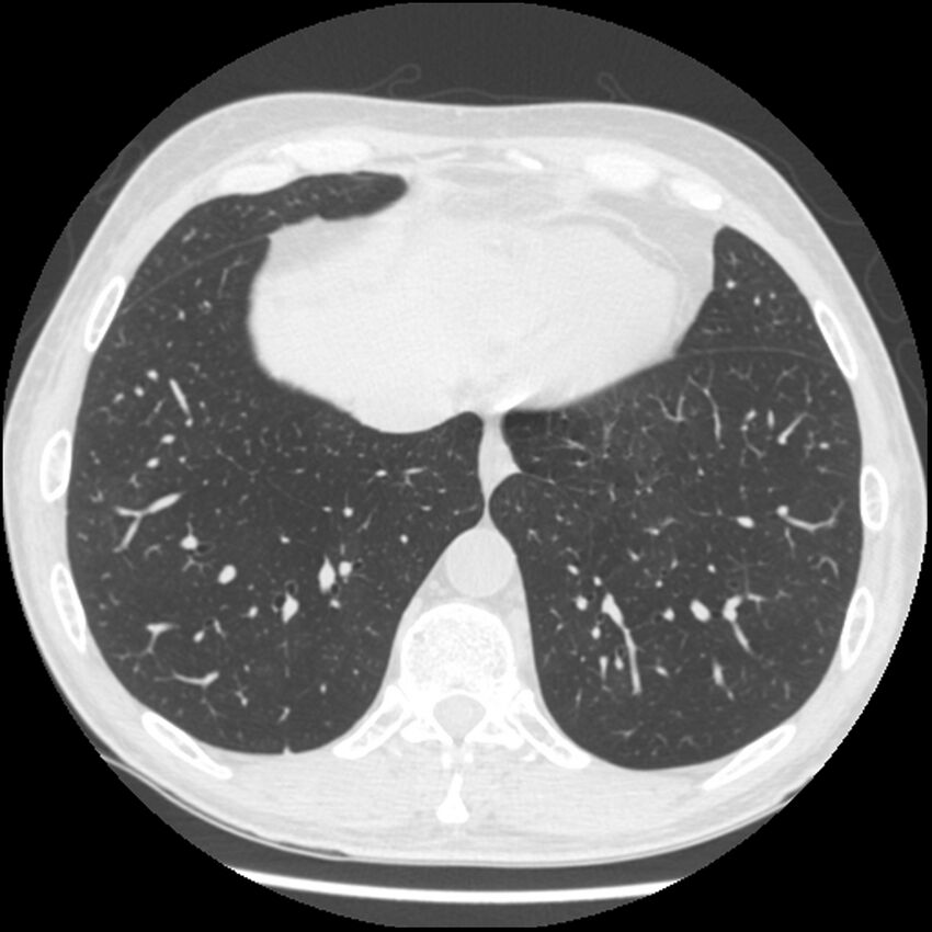 Angioinvasive aspergillosis (Radiopaedia 43957-47466 Axial lung window 53).jpg