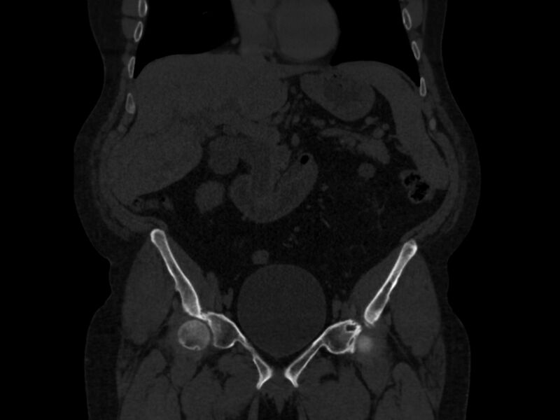 File:Ankylosing spondylitis (Radiopaedia 44609-48357 Coronal bone window 13).jpg