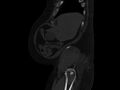 Ankylosing spondylitis (Radiopaedia 44609-48357 Sagittal bone window 5).jpg