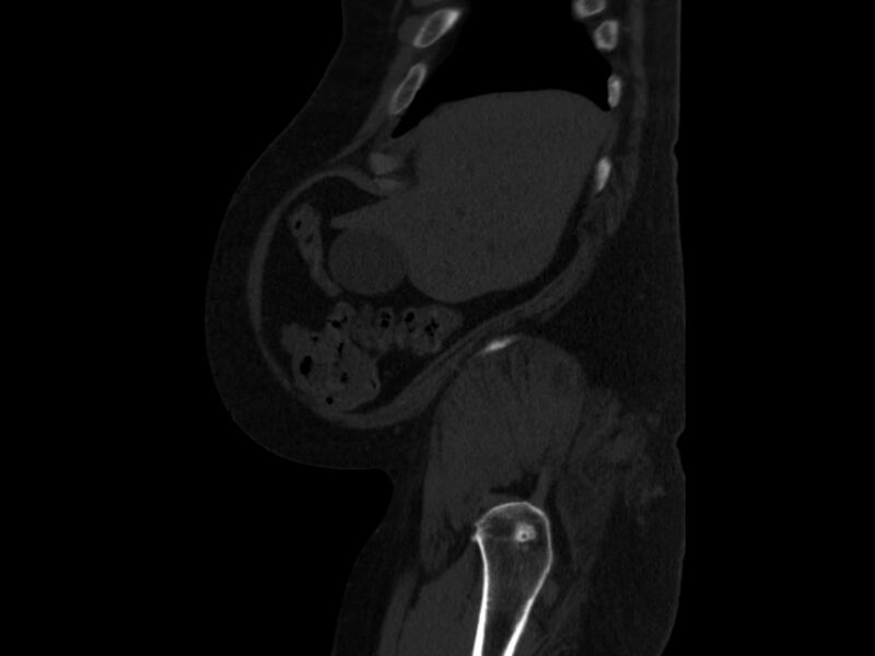 File:Ankylosing spondylitis (Radiopaedia 44609-48357 Sagittal bone window 5).jpg