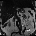 Annular pancreas (Radiopaedia 38292-40320 Coronal T2 12).png