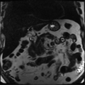 Annular pancreas (Radiopaedia 38292-40320 Coronal T2 18).png