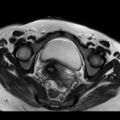 Ano-vaginal fistula (Radiopaedia 29765-30284 E 24).jpg