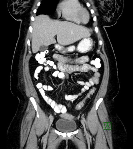 File:Anterior abdominal wall CSF pseudocyst (CSFoma) (Radiopaedia 79453-92571 B 21).jpg