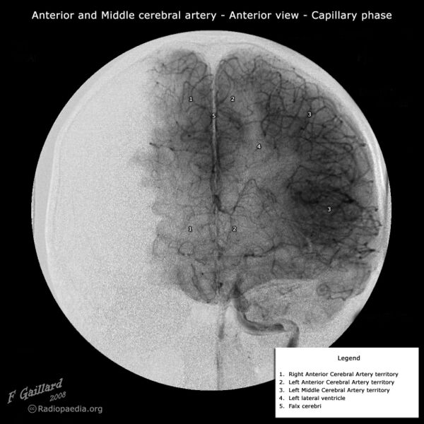 File:Anterior and middle cerebral arteries (annotated cerebral angiogram) (Radiopaedia 36103).jpg